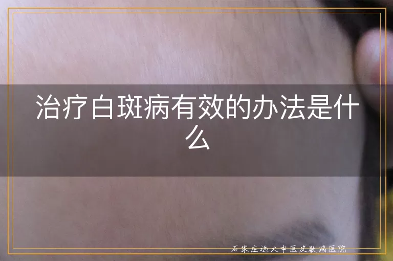治疗白斑病有效的办法是什么