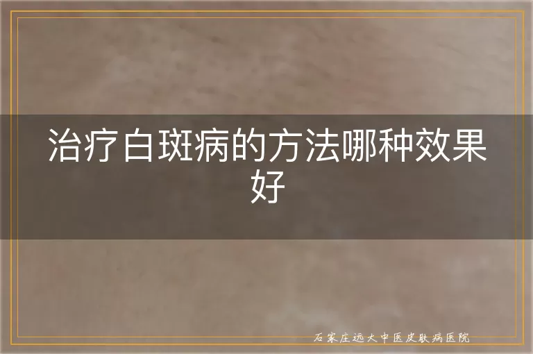 治疗白斑病的方法哪种效果好