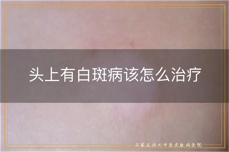 头上有白斑病该怎么治疗