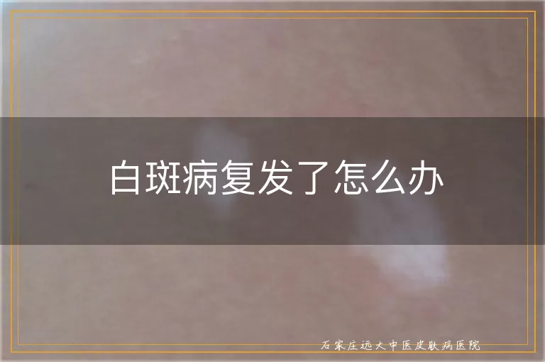 白斑病复发了怎么办