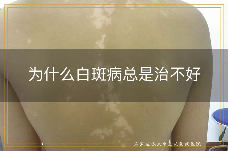 为什么白斑病总是治不好