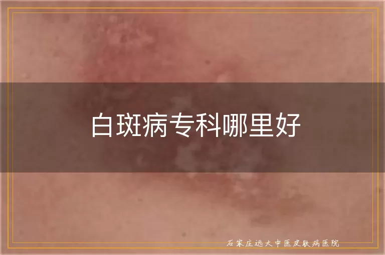 白斑病专科哪里好