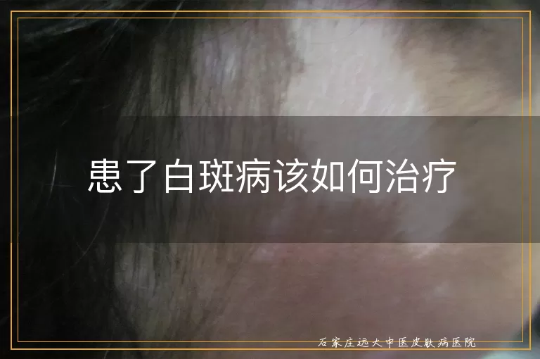 患了白斑病该如何治疗
