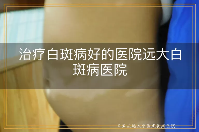 治疗白斑病好的医院远大白斑病医院