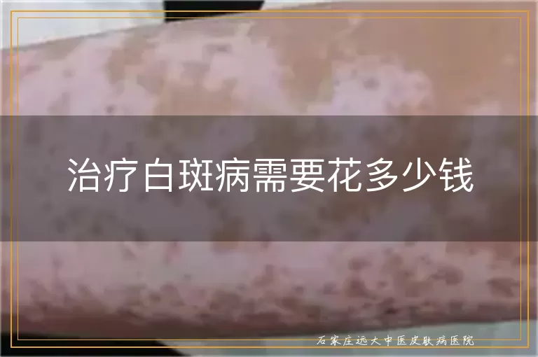 治疗白斑病需要花多少钱