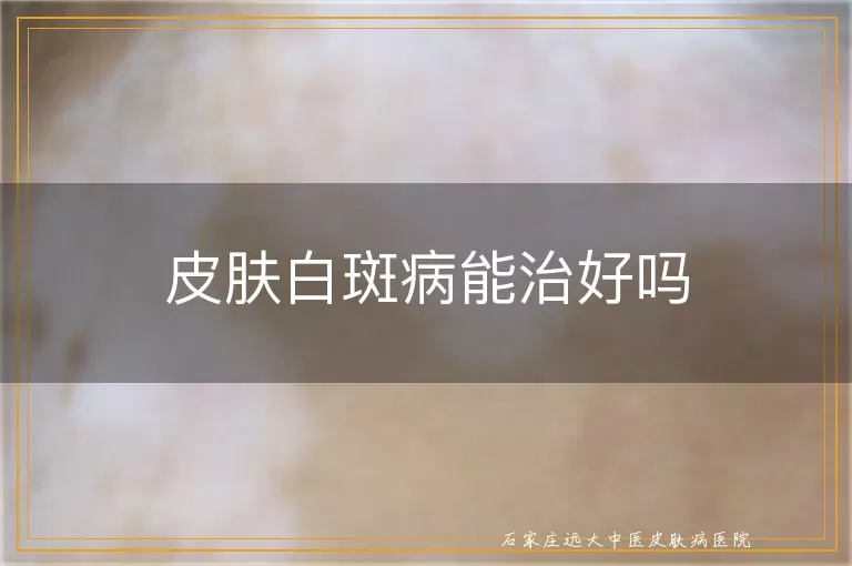 皮肤白斑病能治好吗