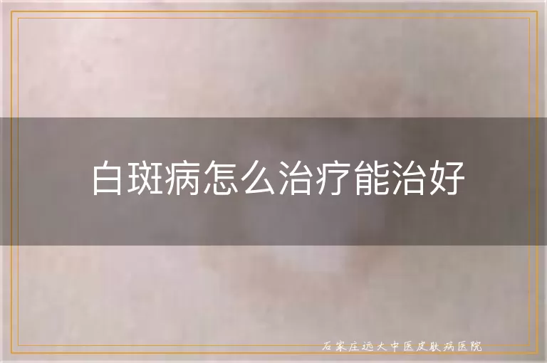 白斑病怎么治疗能治好