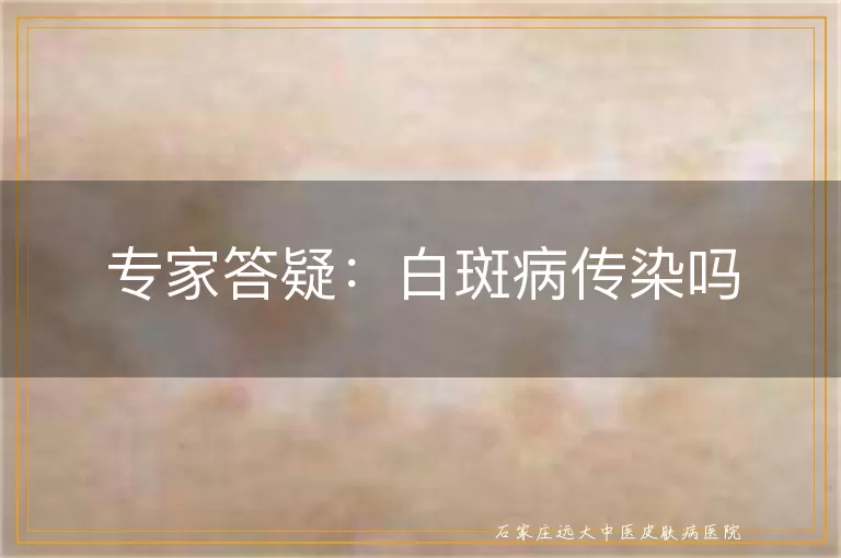 专家答疑：白斑病传染吗