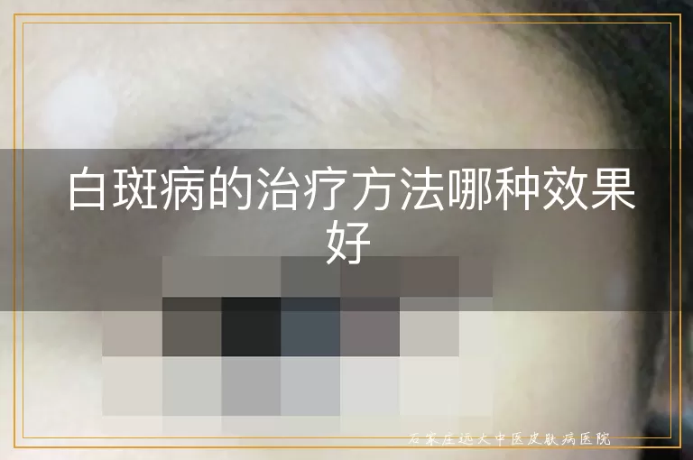 白斑病的治疗方法哪种效果好