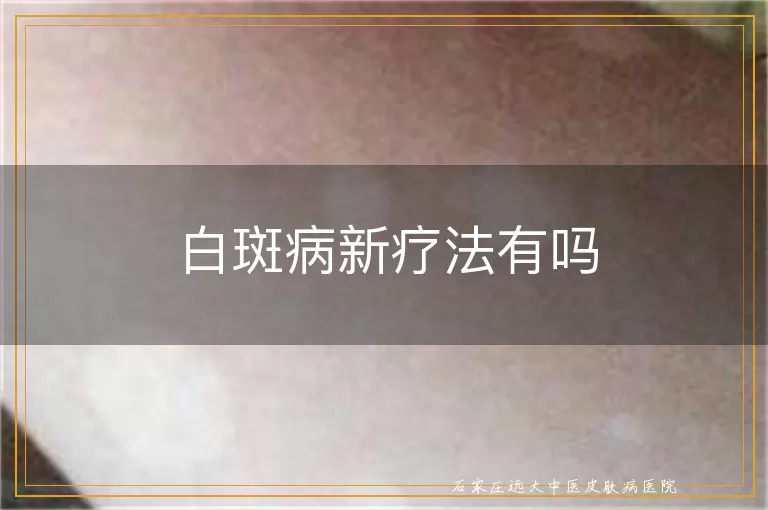 白斑病新疗法有吗