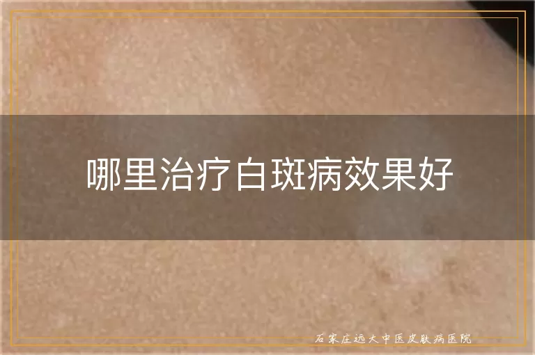 哪里治疗白斑病效果好