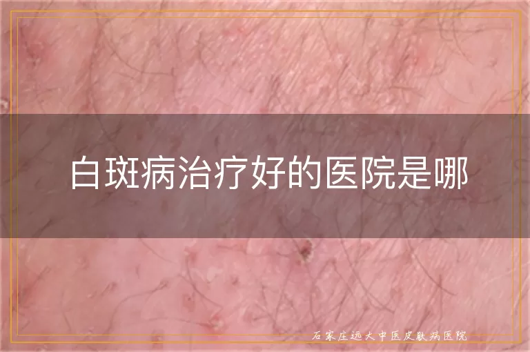 白斑病治疗好的医院是哪
