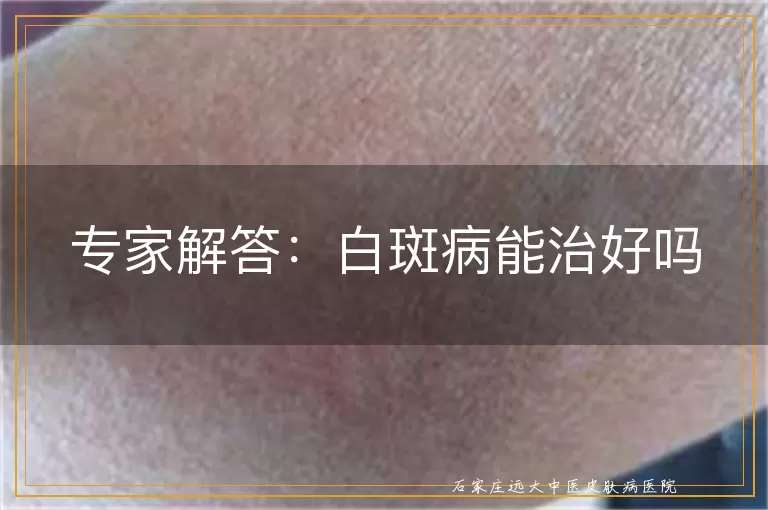 专家解答：白斑病能治好吗
