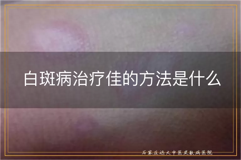 白斑病治疗佳的方法是什么