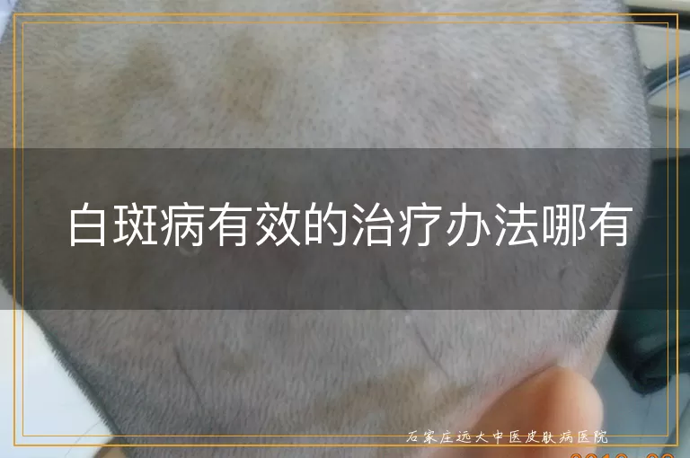 白斑病有效的治疗办法哪有