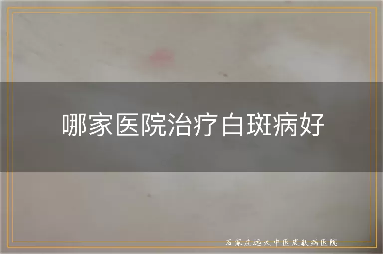 哪家医院治疗白斑病好