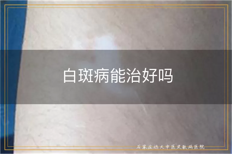 白斑病能治好吗