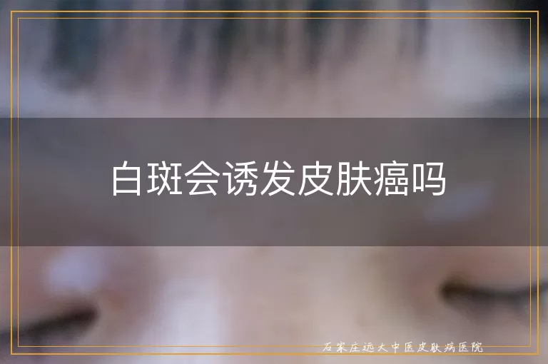 白斑会诱发皮肤癌吗