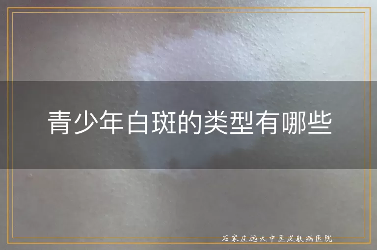 青少年白斑的类型有哪些