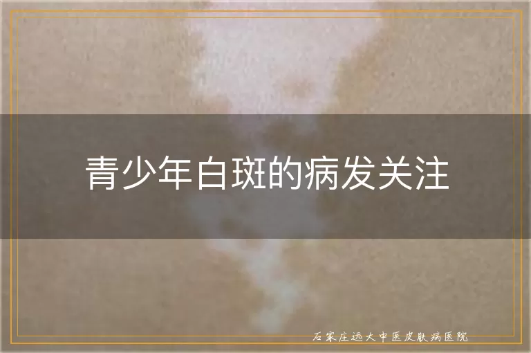 青少年白斑的病发关注