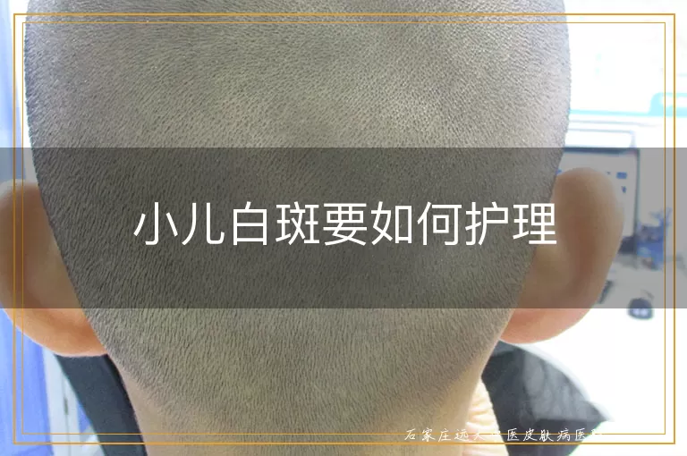 小儿白斑要如何护理