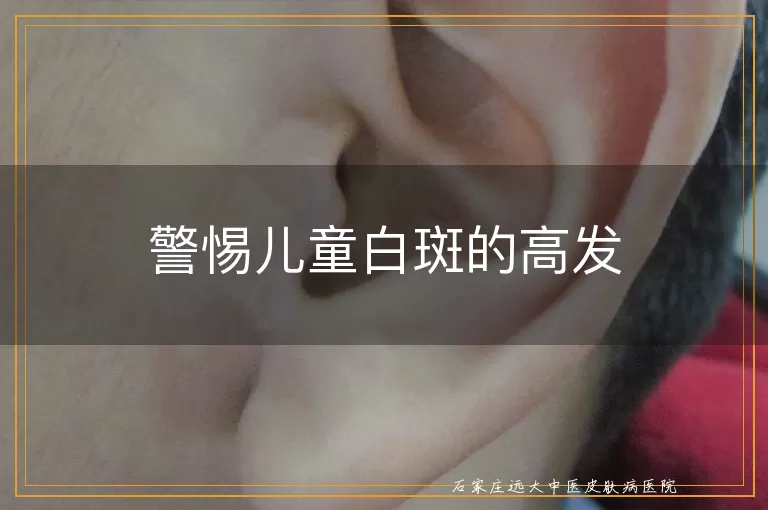 警惕儿童白斑的高发