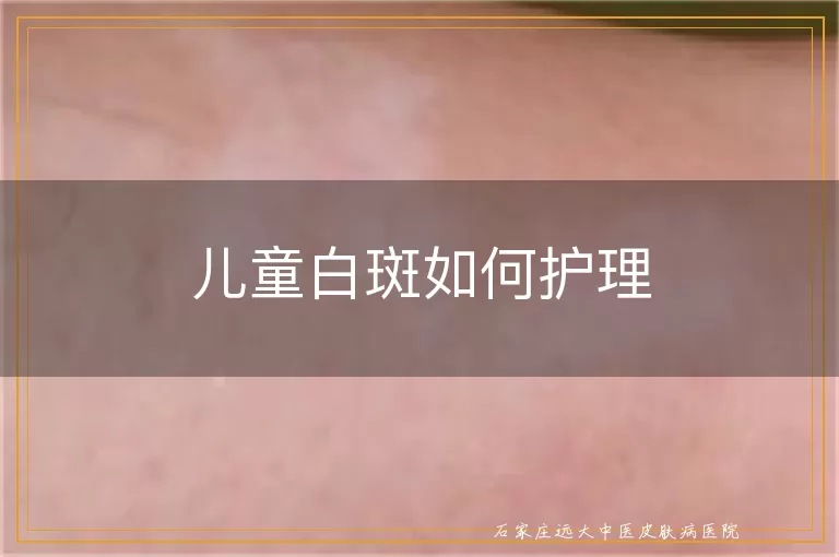 儿童白斑如何护理