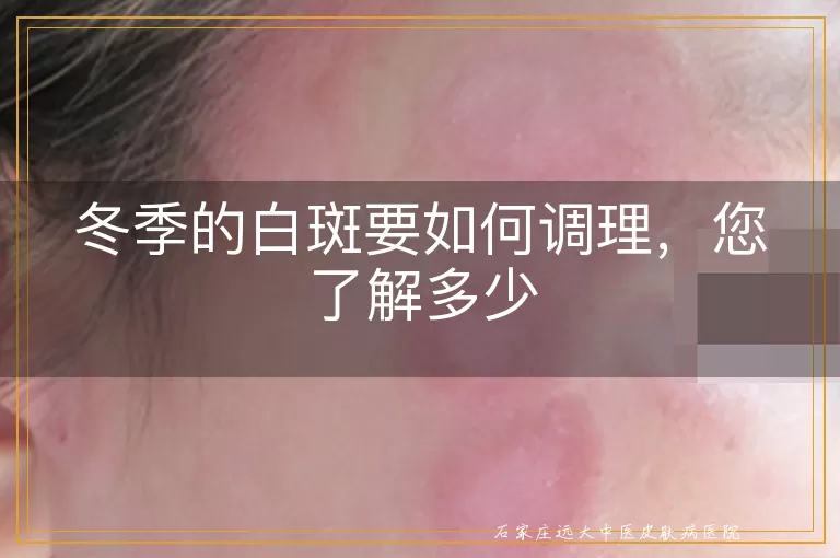 冬季的白斑要如何调理，您了解多少