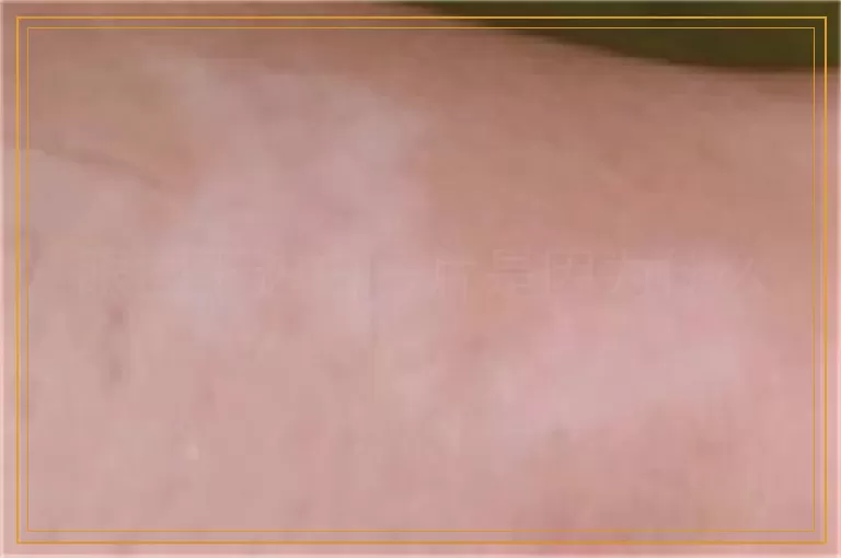 眼圈下边白一片是因为什么