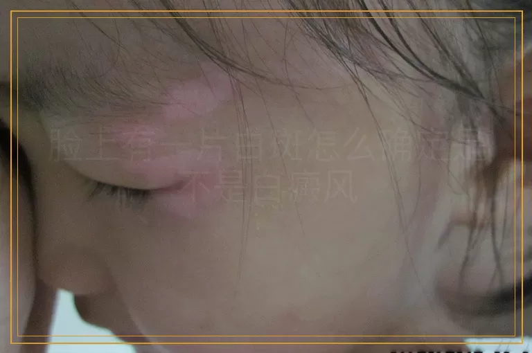 脸上有一片白斑怎么确定是不是白癜风