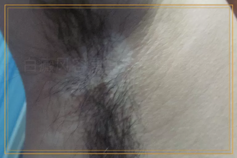 白癜风容易复发移植还有什么用