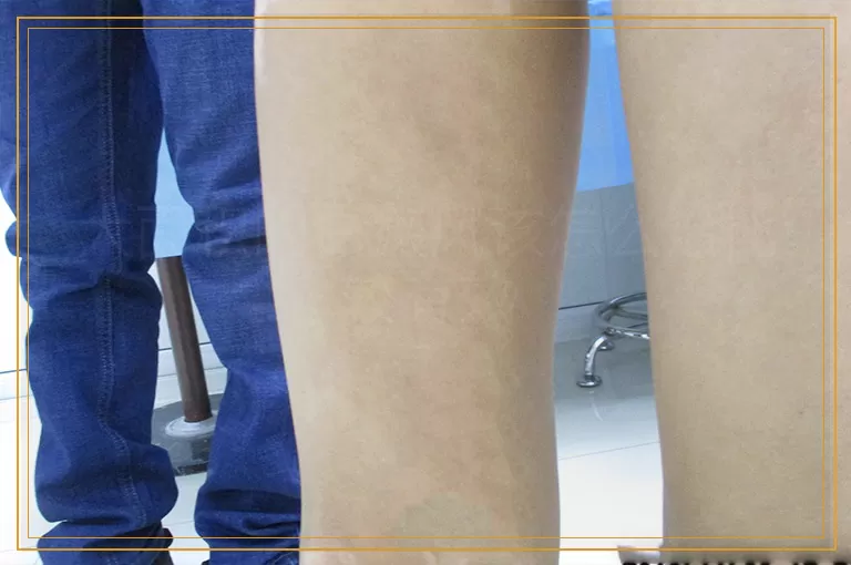 大面积的白癜风该怎么治比较有效