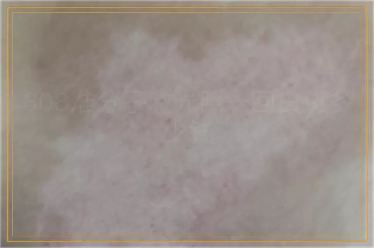 308准分子激光照一回白斑多少钱