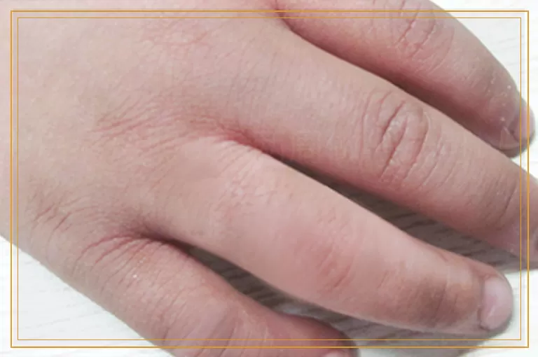 白癜风照308两周做一次可以吗