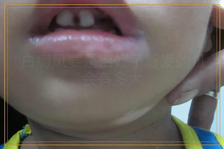 白癜风要是治好了复发的机会有多大