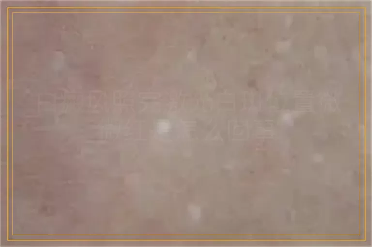 白癜风照完激光白斑位置微微红是怎么回事