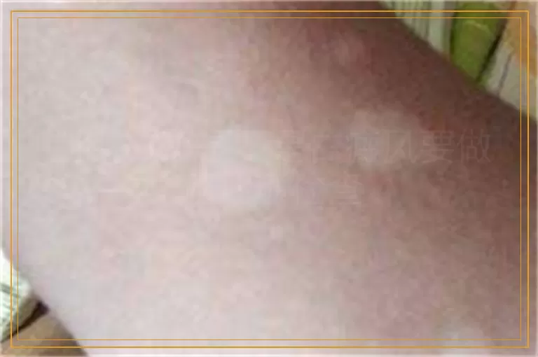 判断白斑是不是白癜风要做哪几项检查