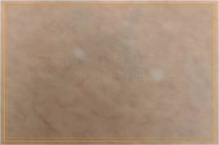 长白癜风一个月没扩散不照308能好吗
