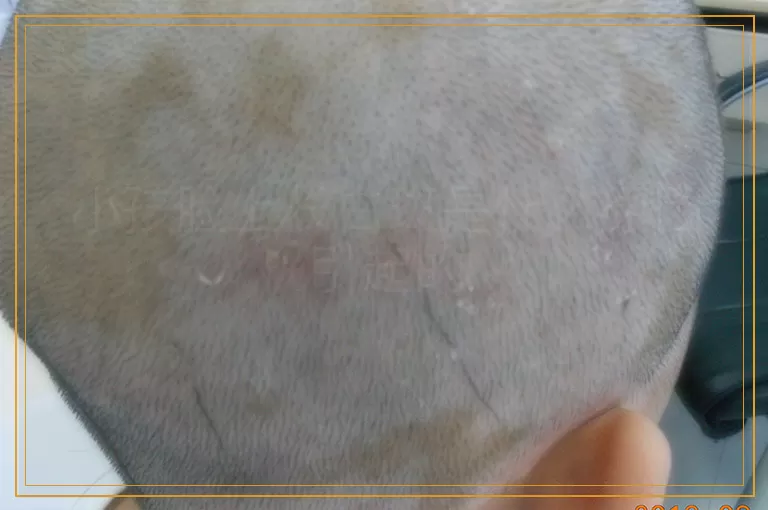 小孩脸上长白斑是什么原因引起的