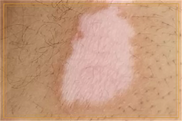 胸口白斑半年照光能治好吗