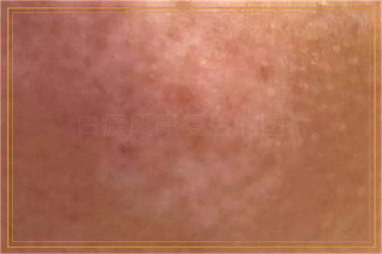 白癜风康复后的图片