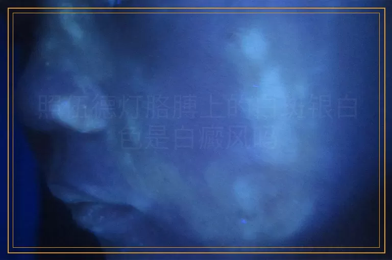 照伍德灯胳膊上的白斑银白色是白癜风吗
