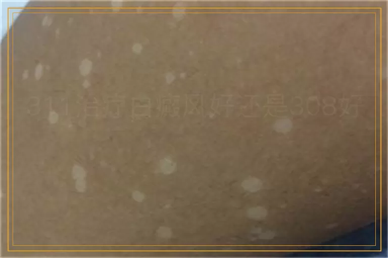 311治疗白癜风好还是308好
