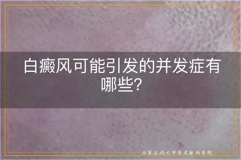 白癜风可能引发的并发症有哪些？