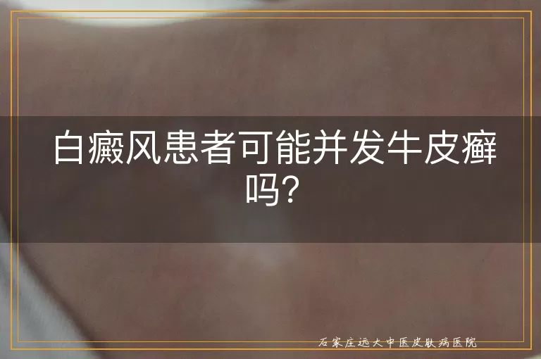 白癜风患者可能并发牛皮癣吗？