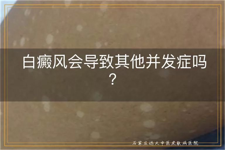 白癜风会导致其他并发症吗？