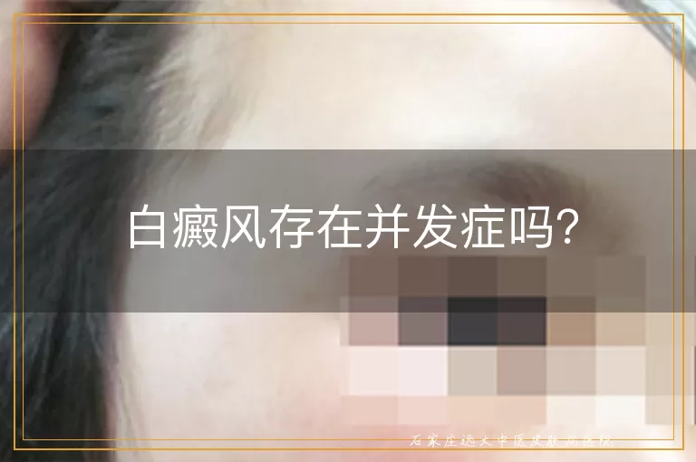白癜风存在并发症吗？