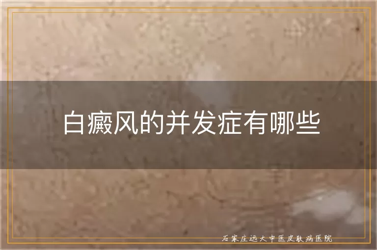 白癜风的并发症有哪些