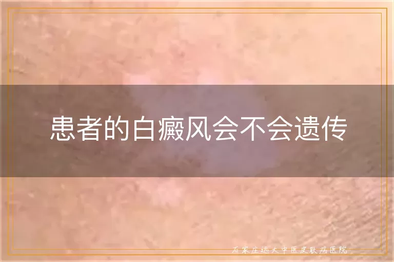 患者的白癜风会不会遗传