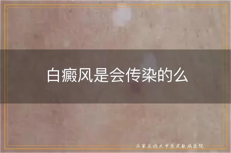 白癜风是会传染的么